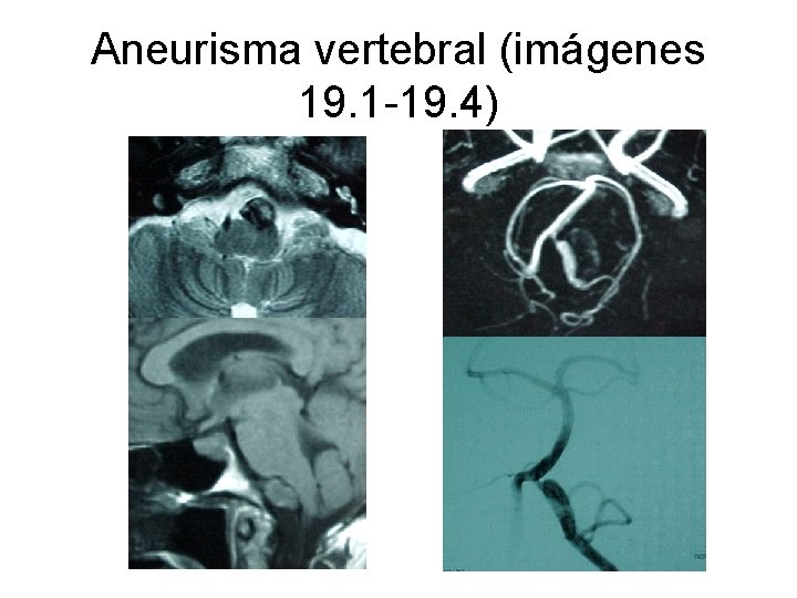 Aneurisma vertebral (imágenes 19. 1 -19. 4) 