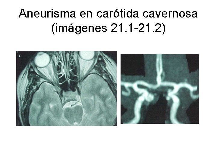 Aneurisma en carótida cavernosa (imágenes 21. 1 -21. 2) 