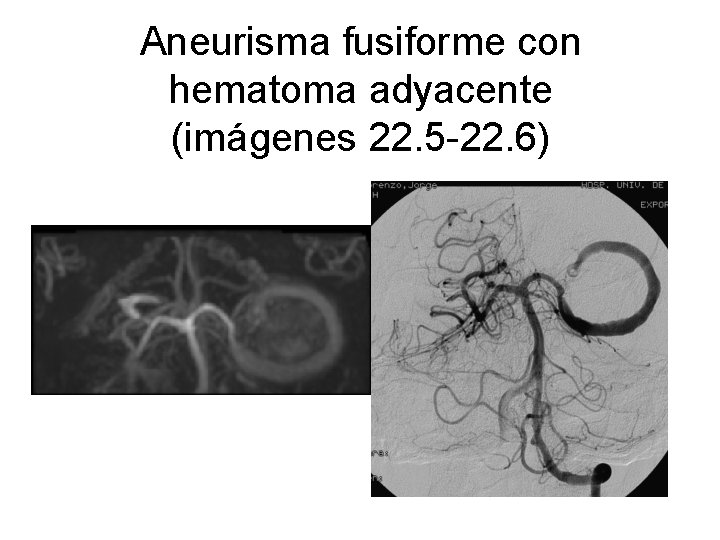 Aneurisma fusiforme con hematoma adyacente (imágenes 22. 5 -22. 6) 