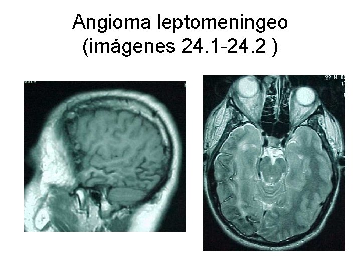 Angioma leptomeningeo (imágenes 24. 1 -24. 2 ) 