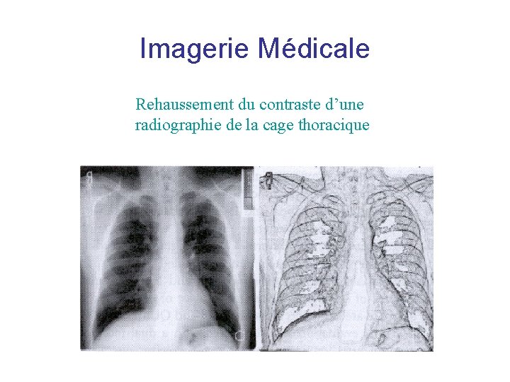Imagerie Médicale Rehaussement du contraste d’une radiographie de la cage thoracique Imagerie Médicale Rehaussement du contraste d’une radiographie de la cage thoracique