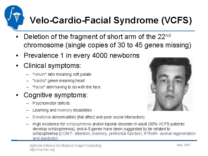 Velo-Cardio-Facial Syndrome (VCFS) • Deletion of the fragment of short arm of the 22