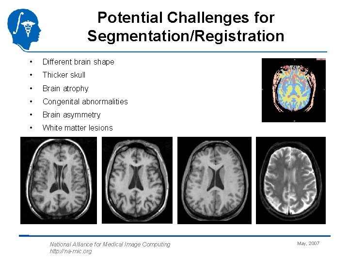 Potential Challenges for Segmentation/Registration • Different brain shape • Thicker skull • Brain atrophy