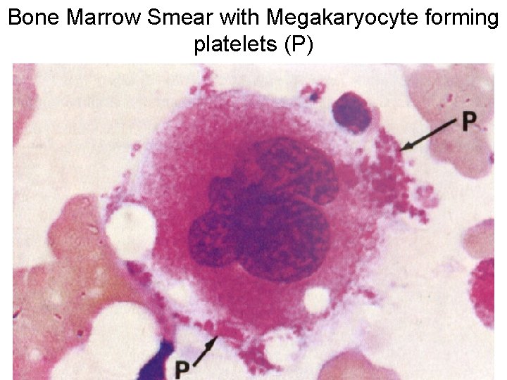 Bone Marrow Smear with Megakaryocyte forming platelets (P) 