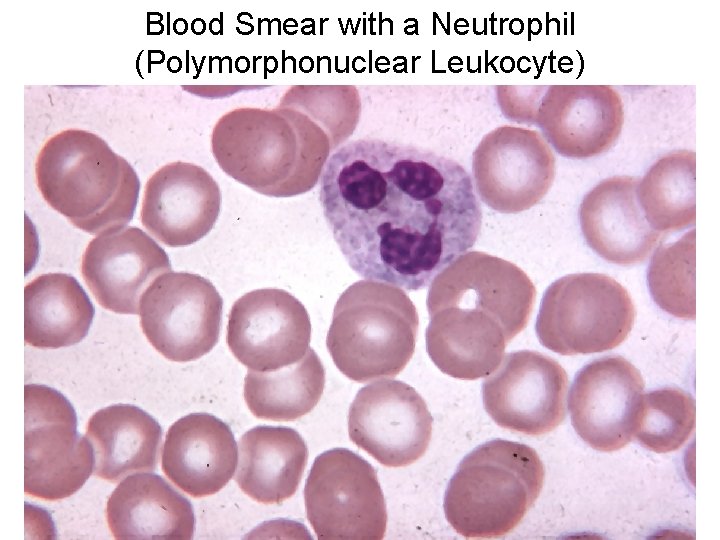 Blood Smear with a Neutrophil (Polymorphonuclear Leukocyte) 