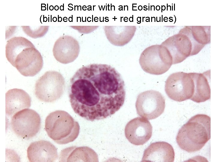 Blood Smear with an Eosinophil (bilobed nucleus + red granules) 