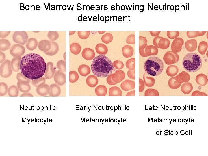 Bone Marrow Smears showing Neutrophil development Neutrophilic Early Neutrophilic Late Neutrophilic Myelocyte Metamyelocyte or