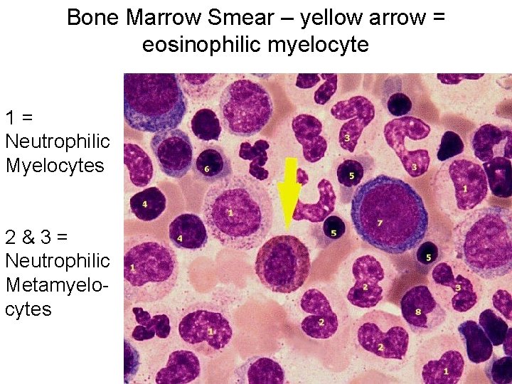 Bone Marrow Smear – yellow arrow = eosinophilic myelocyte 1= Neutrophilic Myelocytes 2&3= Neutrophilic