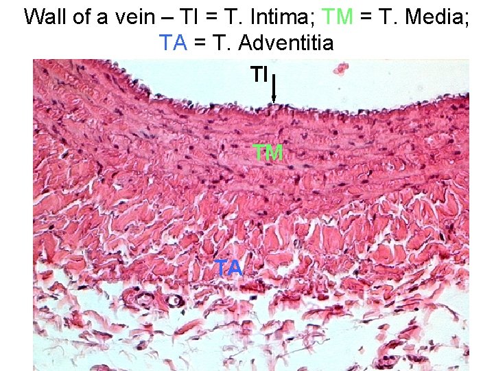 Wall of a vein – TI = T. Intima; TM = T. Media; TA