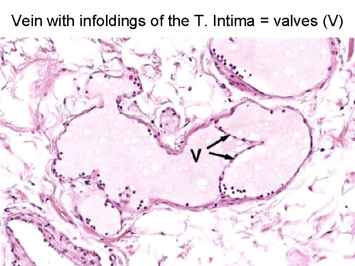 Vein with infoldings of the T. Intima = valves (V) 