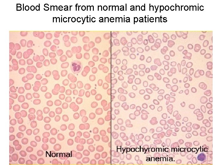 Blood Smear from normal and hypochromic microcytic anemia patients 