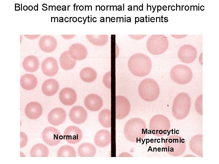 Blood Smear from normal and hyperchromic macrocytic anemia patients Normal Macrocytic Hyperchromic Anemia 