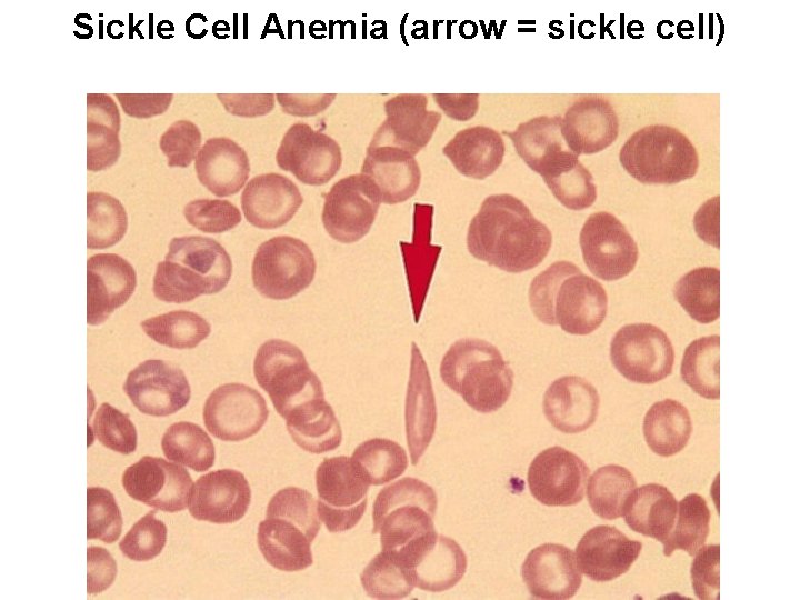 Sickle Cell Anemia (arrow = sickle cell) 