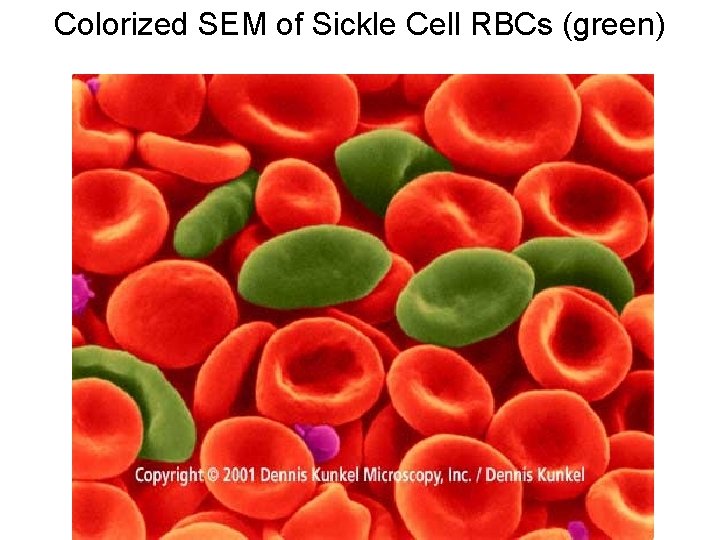 Colorized SEM of Sickle Cell RBCs (green) 