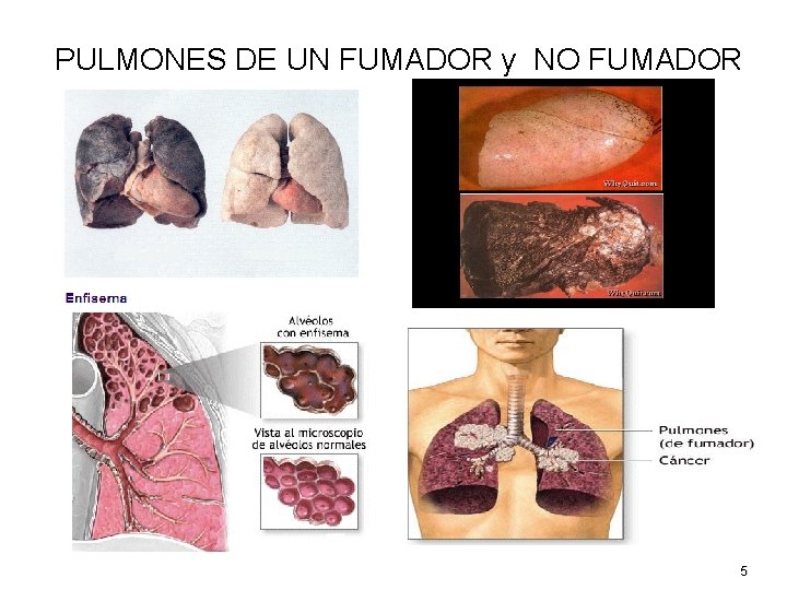 PULMONES DE UN FUMADOR y NO FUMADOR 5 