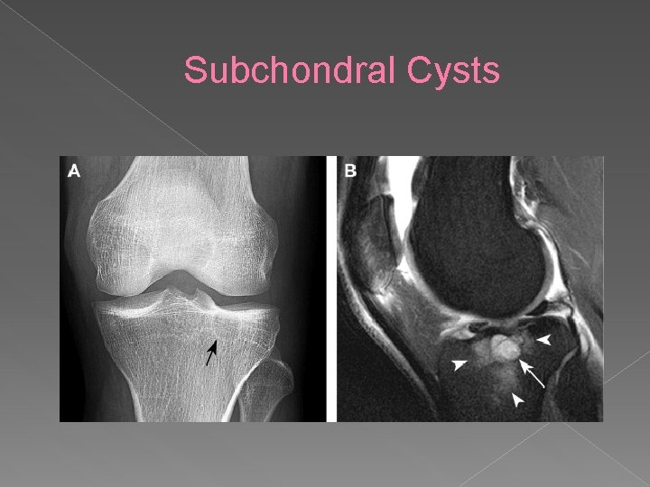 Subchondral Cysts 