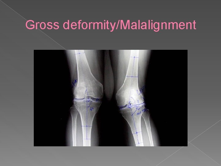 Gross deformity/Malalignment 