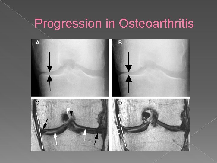 Progression in Osteoarthritis 