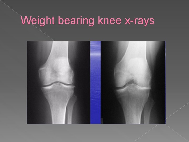 Weight bearing knee x-rays 