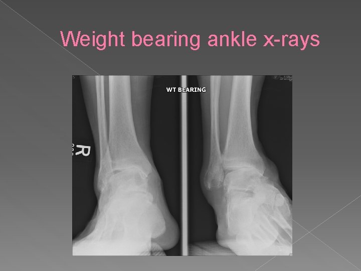 Weight bearing ankle x-rays 