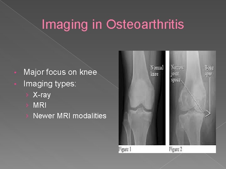 Imaging in Osteoarthritis Major focus on knee • Imaging types: • › X-ray ›