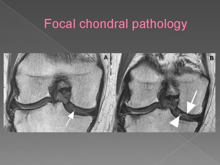 Focal chondral pathology 