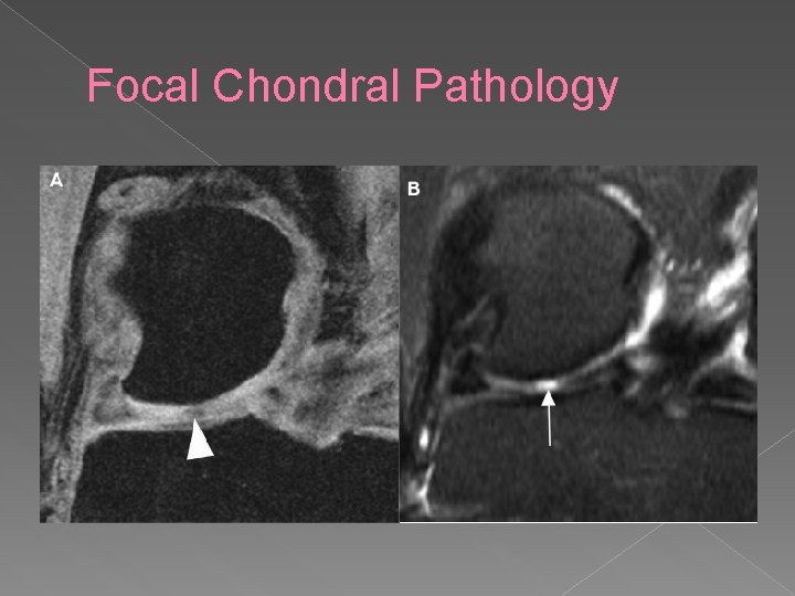 Focal Chondral Pathology 