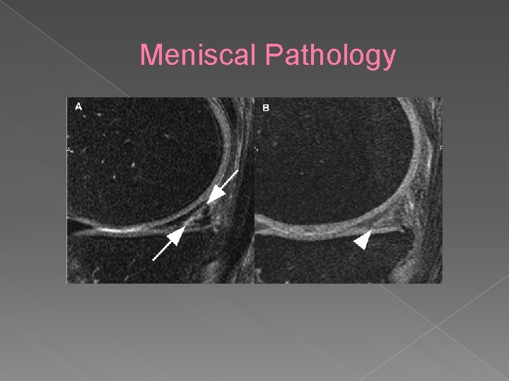 Meniscal Pathology 