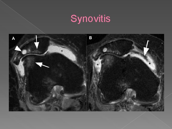 Synovitis 