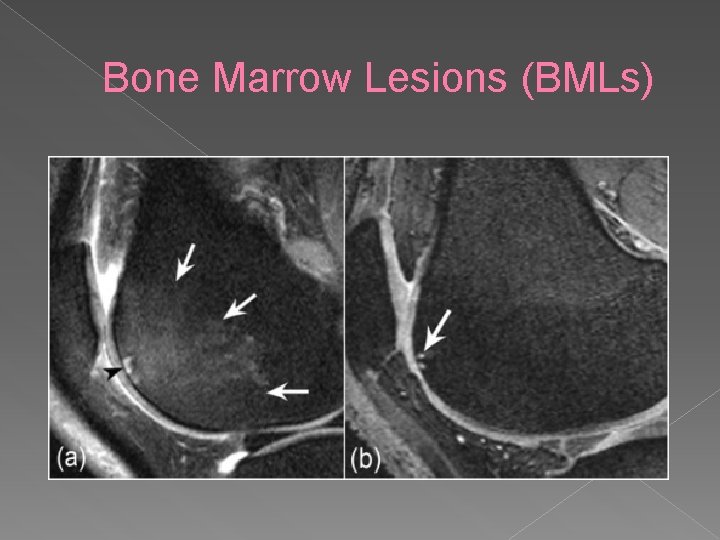 Bone Marrow Lesions (BMLs) 