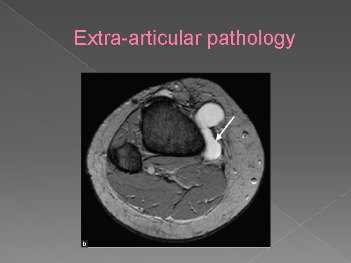 Extra-articular pathology 