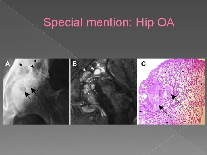 Special mention: Hip OA 