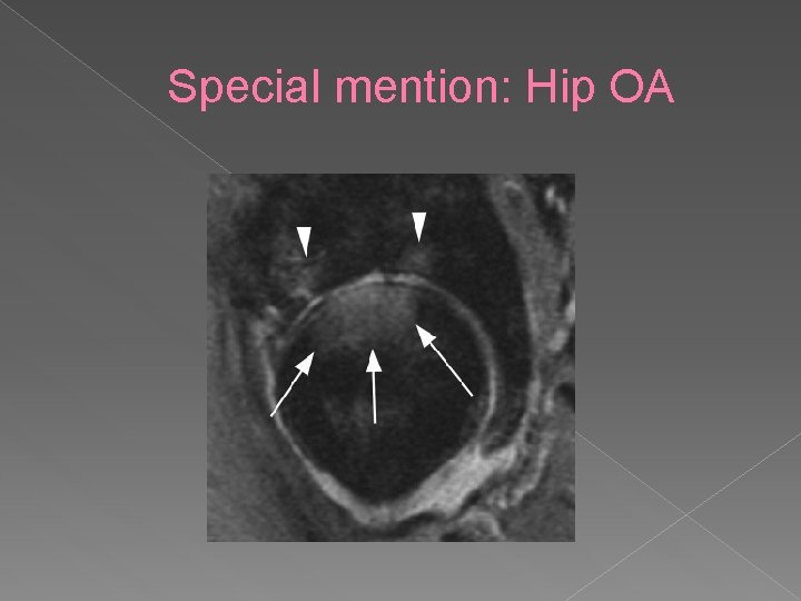 Special mention: Hip OA 