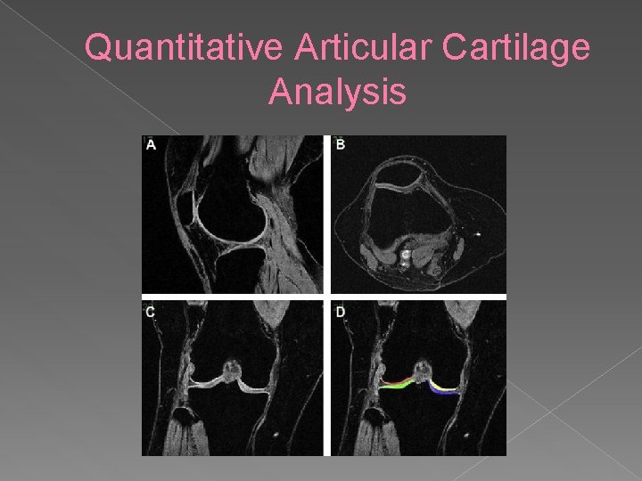 Quantitative Articular Cartilage Analysis 