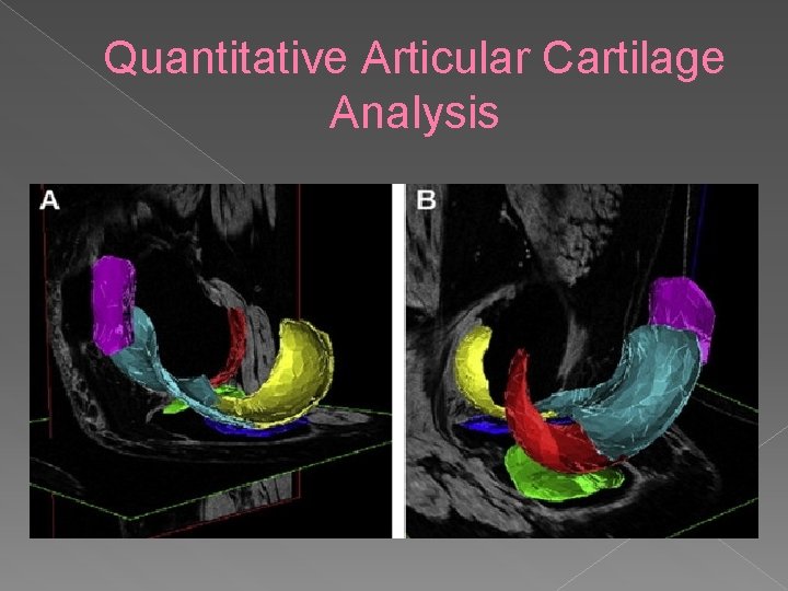 Quantitative Articular Cartilage Analysis 
