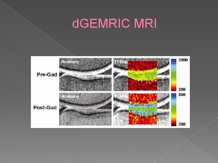 d. GEMRIC MRI 