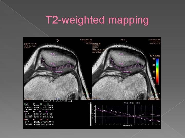 T 2 -weighted mapping 