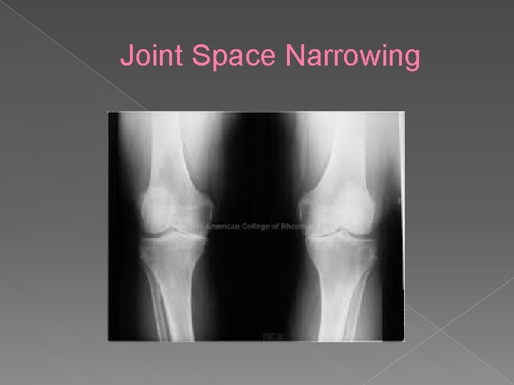 Joint Space Narrowing 