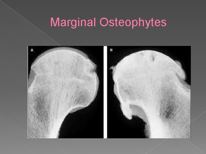 Marginal Osteophytes 