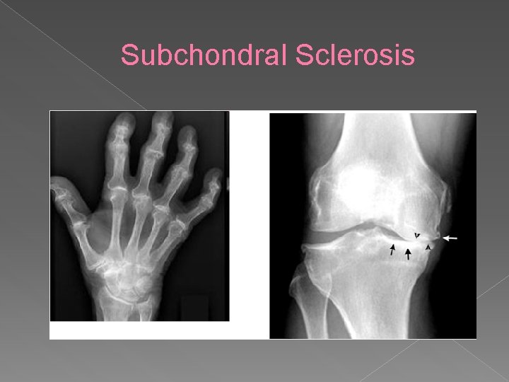 Subchondral Sclerosis 