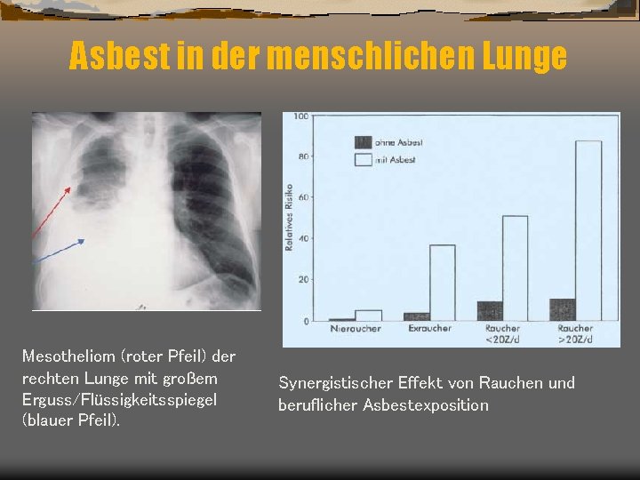 Asbest in der menschlichen Lunge Mesotheliom (roter Pfeil) der rechten Lunge mit großem Erguss/Flüssigkeitsspiegel