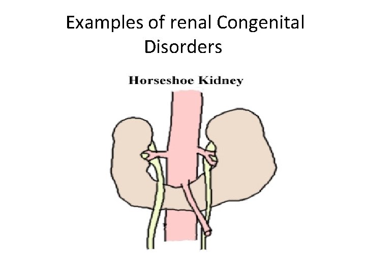 Examples of renal Congenital Disorders 