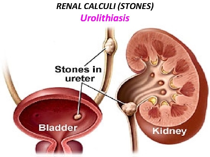 RENAL CALCULI (STONES) Urolithiasis 