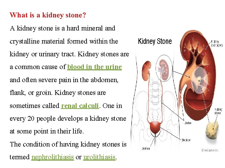 What is a kidney stone? A kidney stone is a hard mineral and crystalline