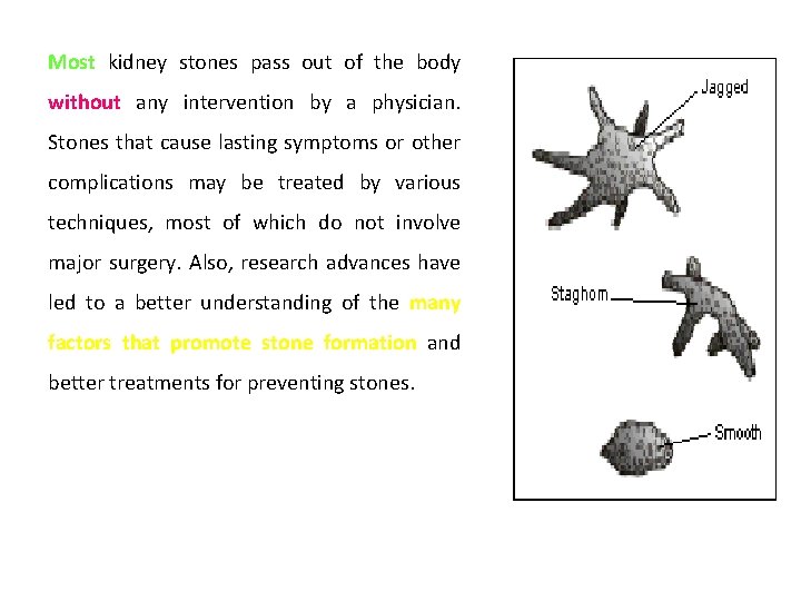 Most kidney stones pass out of the body without any intervention by a physician.