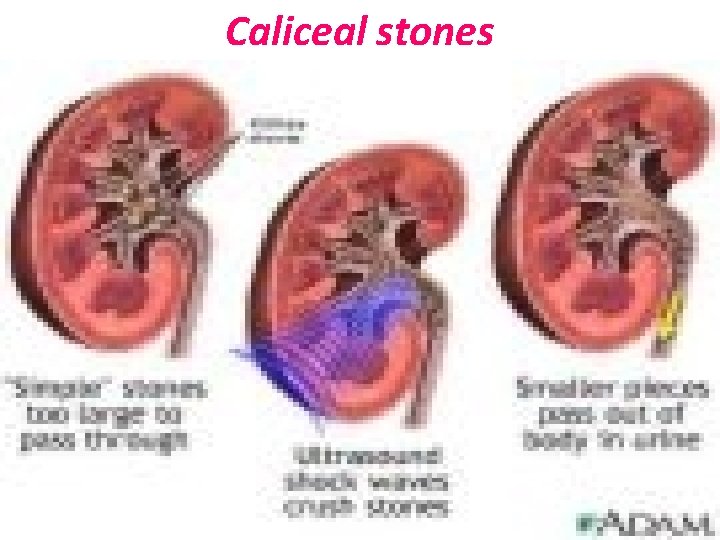 Caliceal stones 