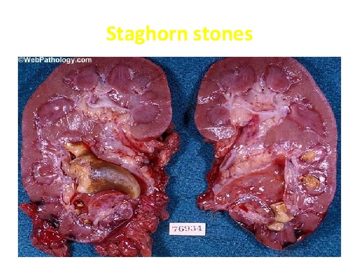 Staghorn stones 
