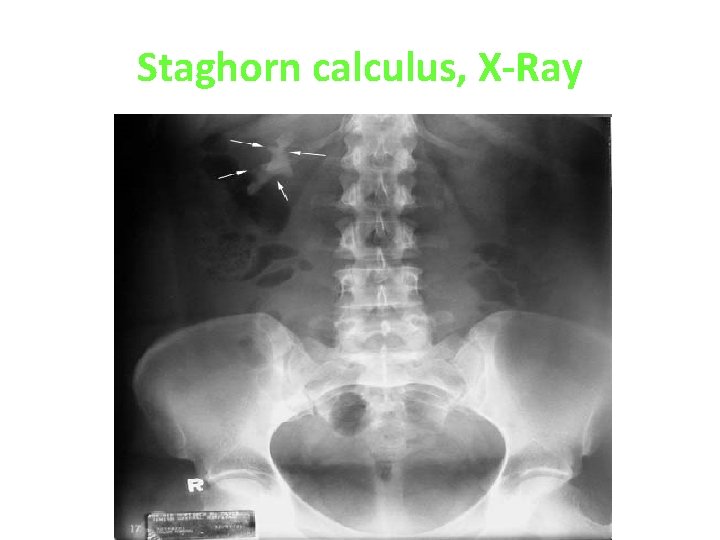 Staghorn calculus, X-Ray 