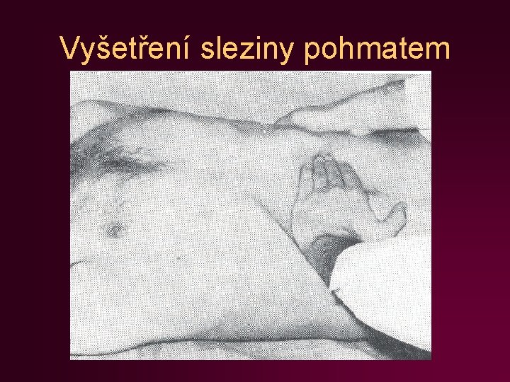 Vyšetření sleziny pohmatem 