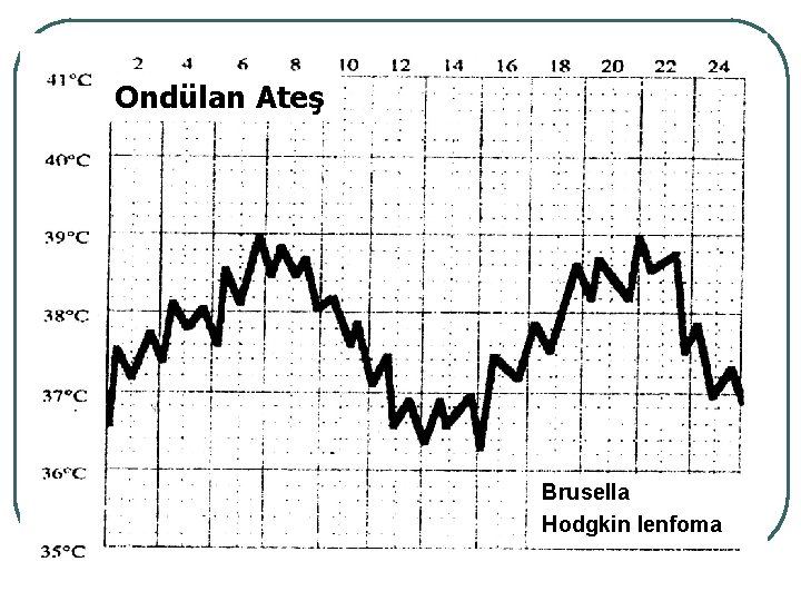 Ondülan Ateş Brusella Hodgkin lenfoma 